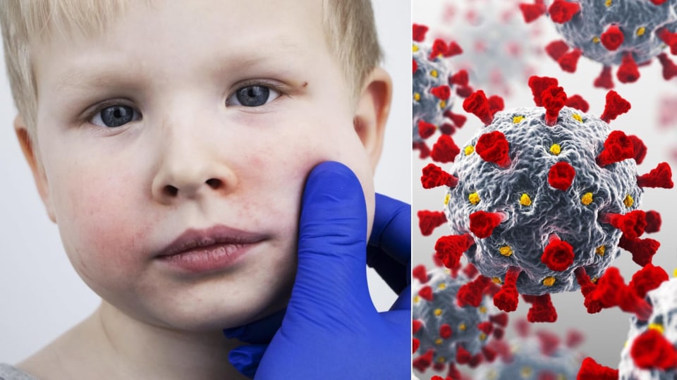 COVID-19 u dětí může způsobit silnou vyrážku